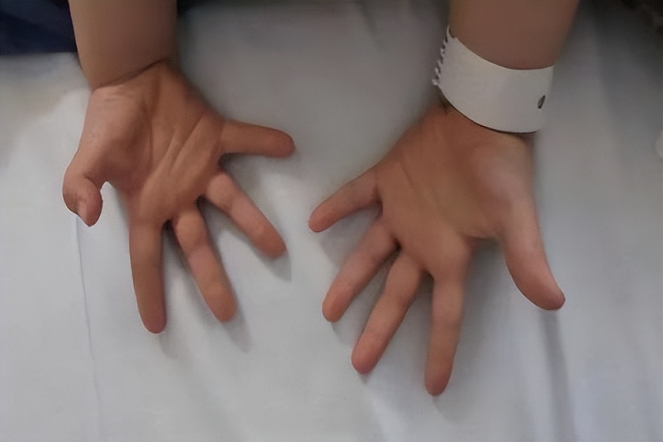 宝宝手长怎么办,宝宝手指长硬皮怎么回事