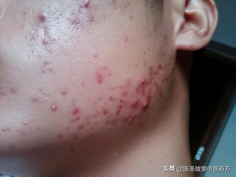 龙胆泻肝汤治荨麻疹医案,蛇缠腰中药方龙胆泻肝汤