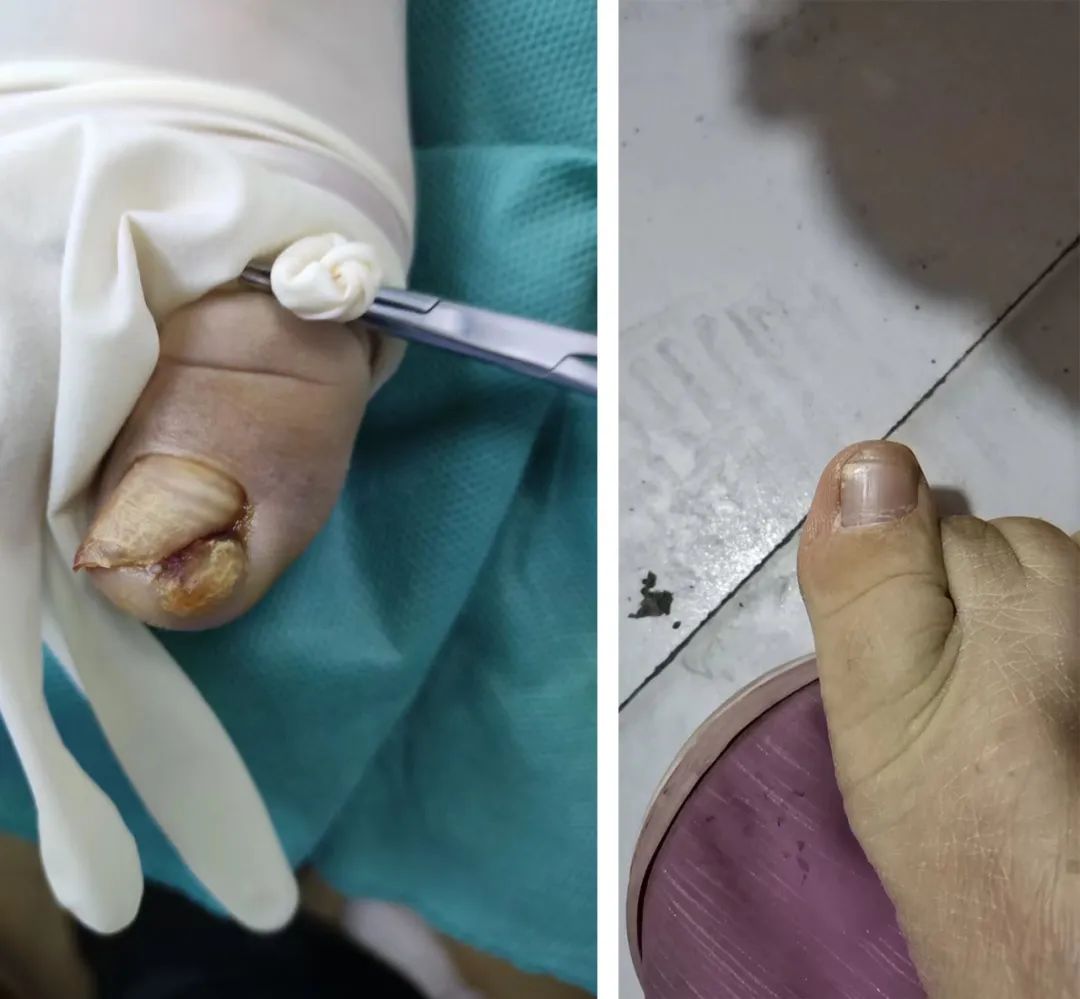 怎么治疗甲沟炎最快最好的方法,如何治疗甲沟炎效果最佳