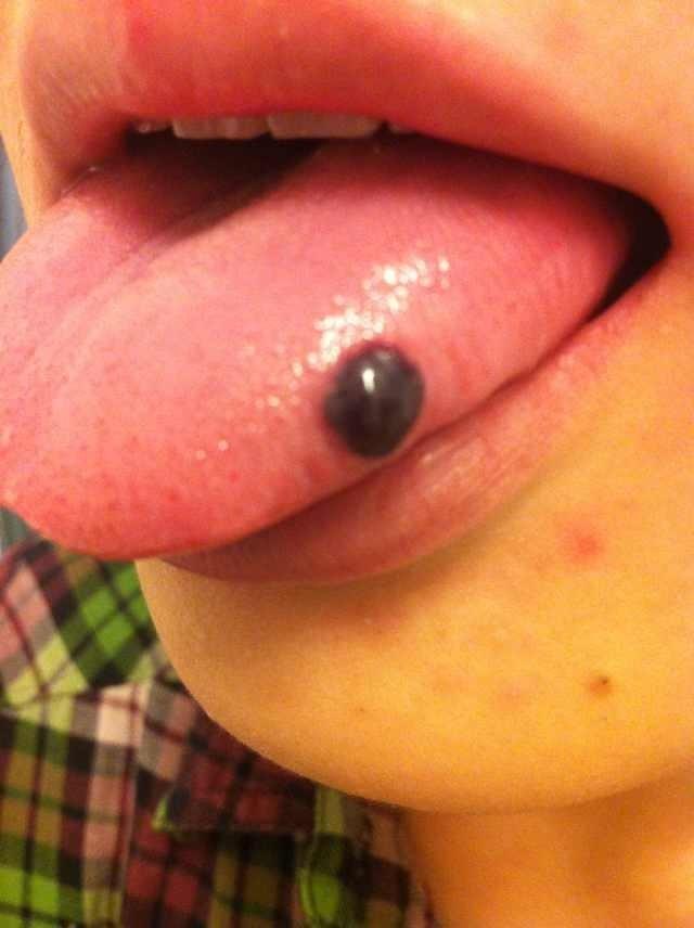 嘴里吃东西咬出黑血泡是咋回事,嘴里吃东西经常起血包怎么回事