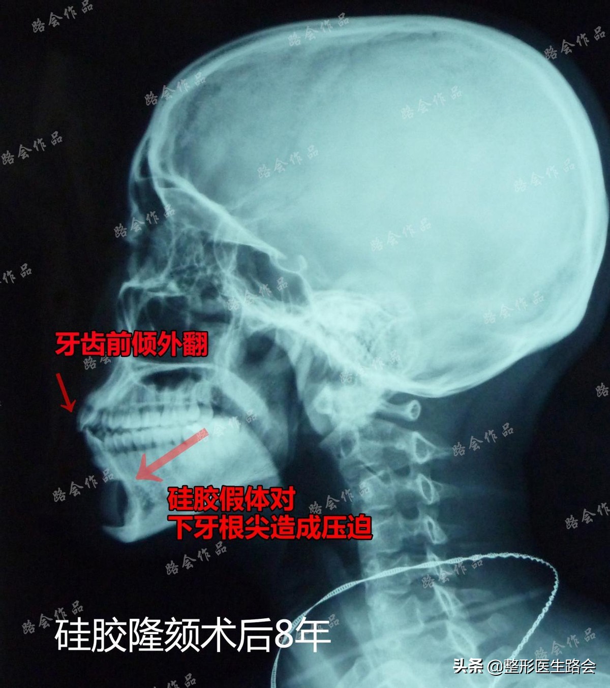 瞒着老爸，在北京隆下巴：22岁东*姑北**娘80天甩掉“肉乎乎包子脸”