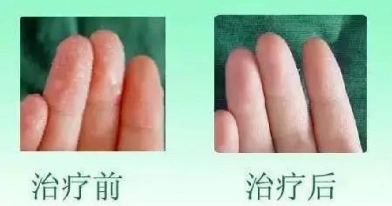 手心长期出汗是什么原因怎样治疗,手心出汗多的原因及解决方法