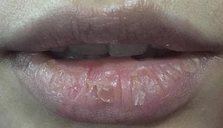 嘴唇不好，要找脾，中医温脾来治唇干裂