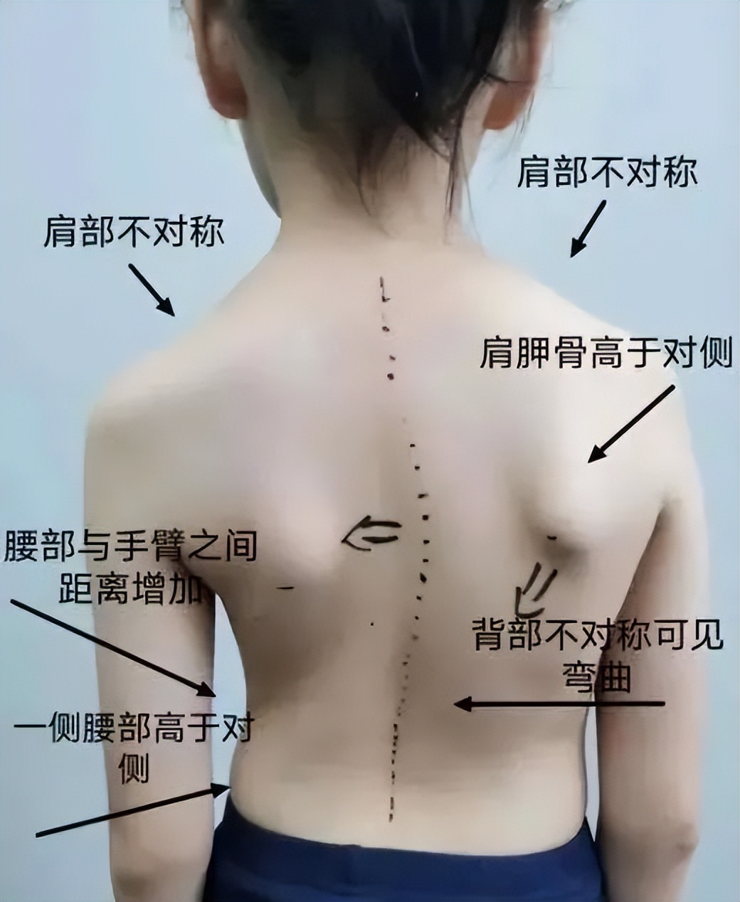 河北省儿童脊柱侧弯筛查,邢台市青少年脊柱侧弯筛查