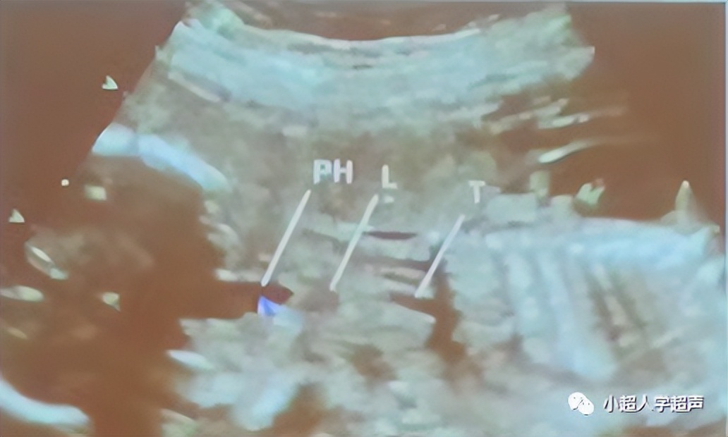 食道闭锁超声表现,食管闭锁一型手术过程