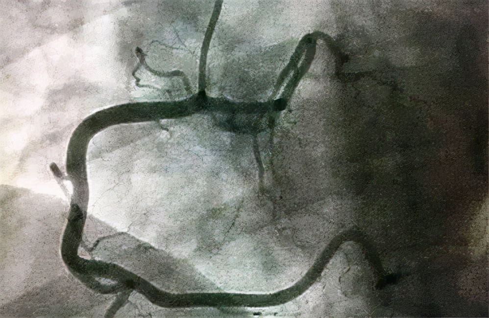 冠脉造影对身体有多大影响,做了冠脉造影对周围有辐射吗