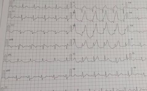 突发急性心梗做支架,急性心梗溶栓后还需要支架治疗吗