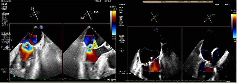 郑州大学第一附属医院心脏瓣膜,新技术治疗心脏瓣膜病