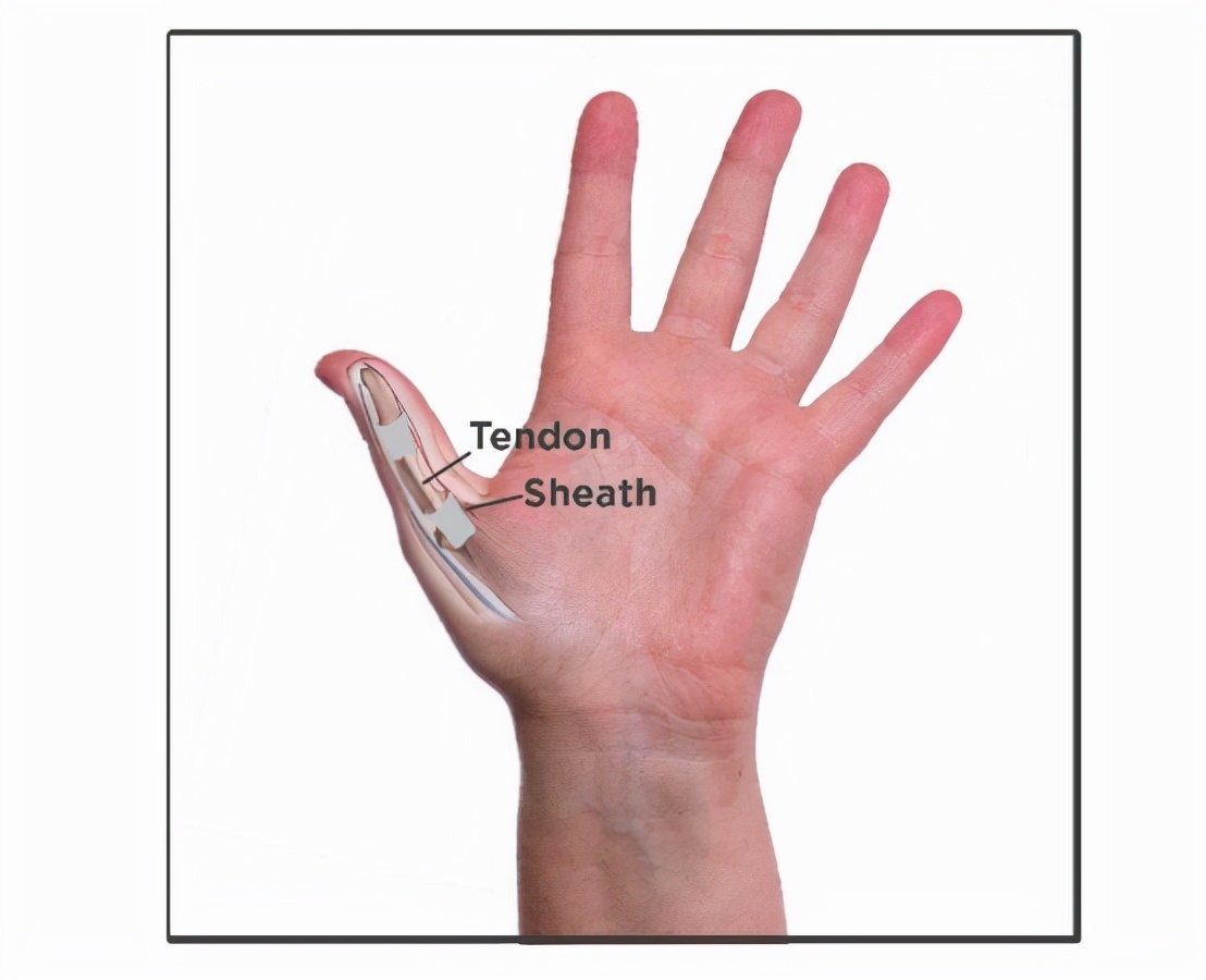 更年期女性手指腱鞘炎,女性绝经易患屈指腱鞘炎吗