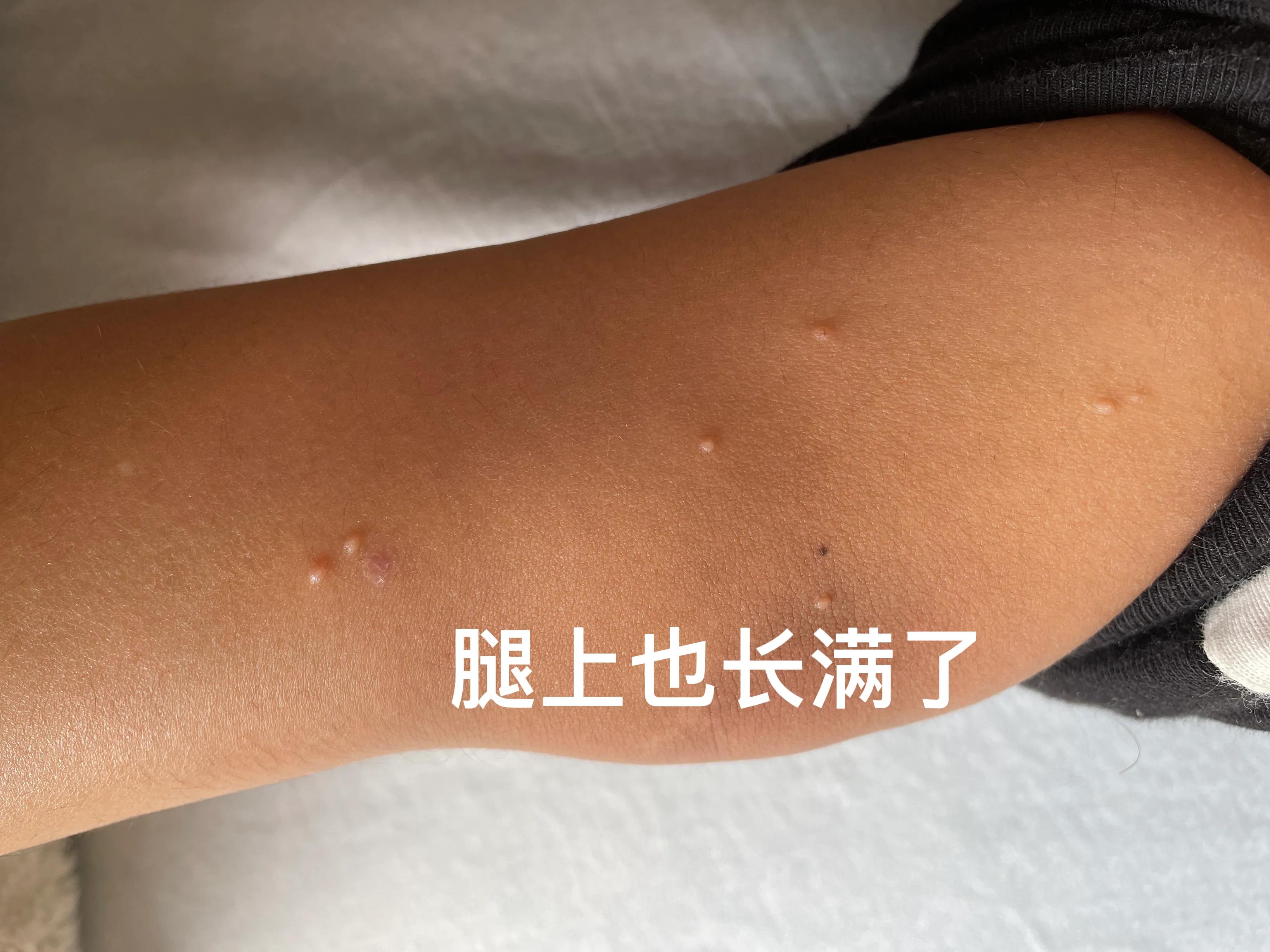 包皮传染性软疣自愈,传染性软疣多久可以自愈