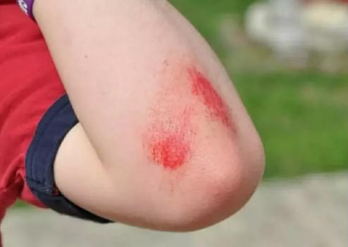 孩子磕碰怎么办,小孩子磕碰划伤擦什么药好