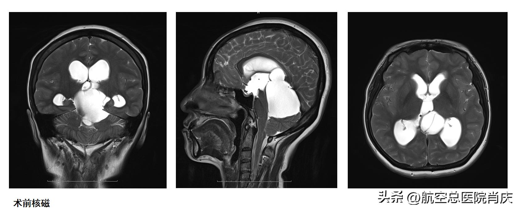 脑积水神经内镜微创是怎么回事,软性神经内镜治脑积水费用