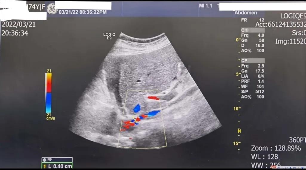 双下肢水肿心源性,心衰双下肢水肿