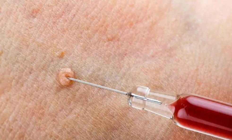 脖子上和腋下的小肉粒是什么原因,颈部和腋窝有小肉粒怎么消除