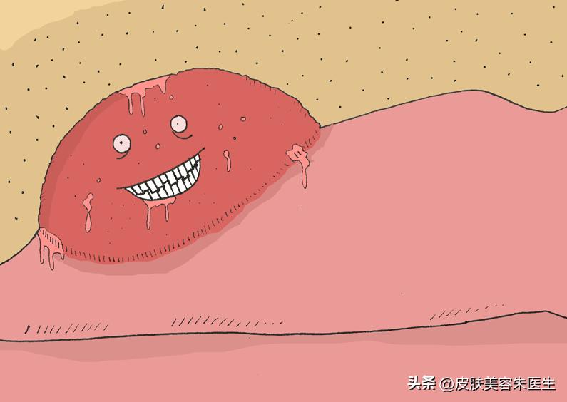 害怕自己得了尖端湿疣用什么预防,担心自己得了尖锐性湿疣怎么排除