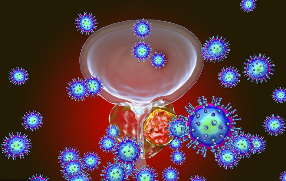 前列腺钙化的5大危害,前列腺钙化有什么危害