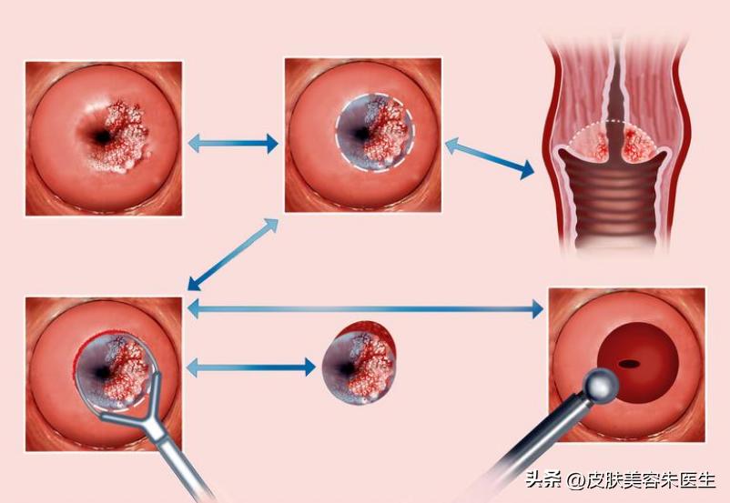 醋酸白阳性是得了hpv吗,醋酸白试验可能是假性湿疣吗