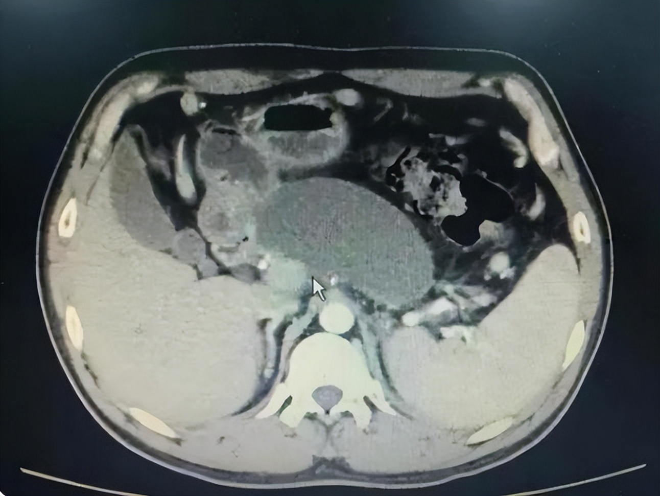 医生说囊肿是良性的但是需要手术,医生说是囊肿是什么意思