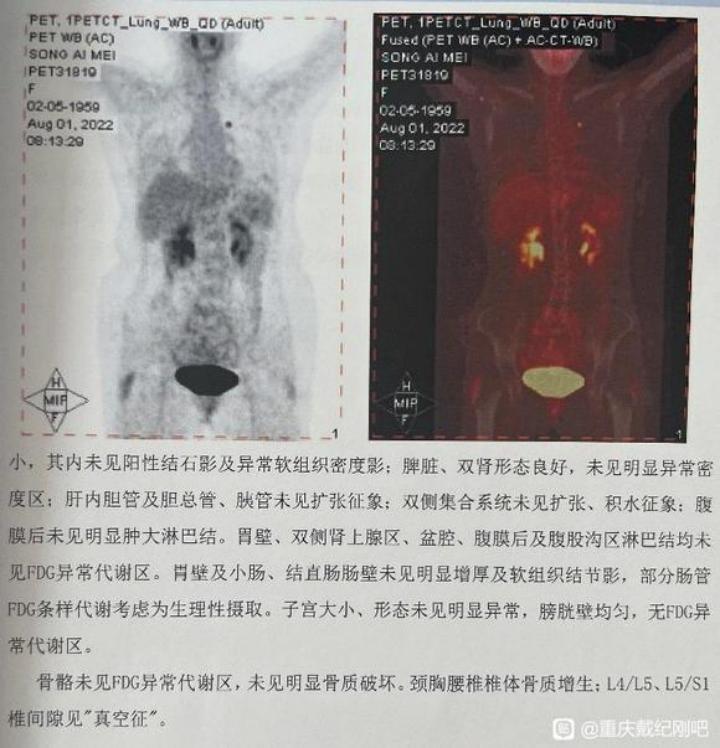 3个月内磨玻璃结节,多发磨玻璃结节3个月后减少