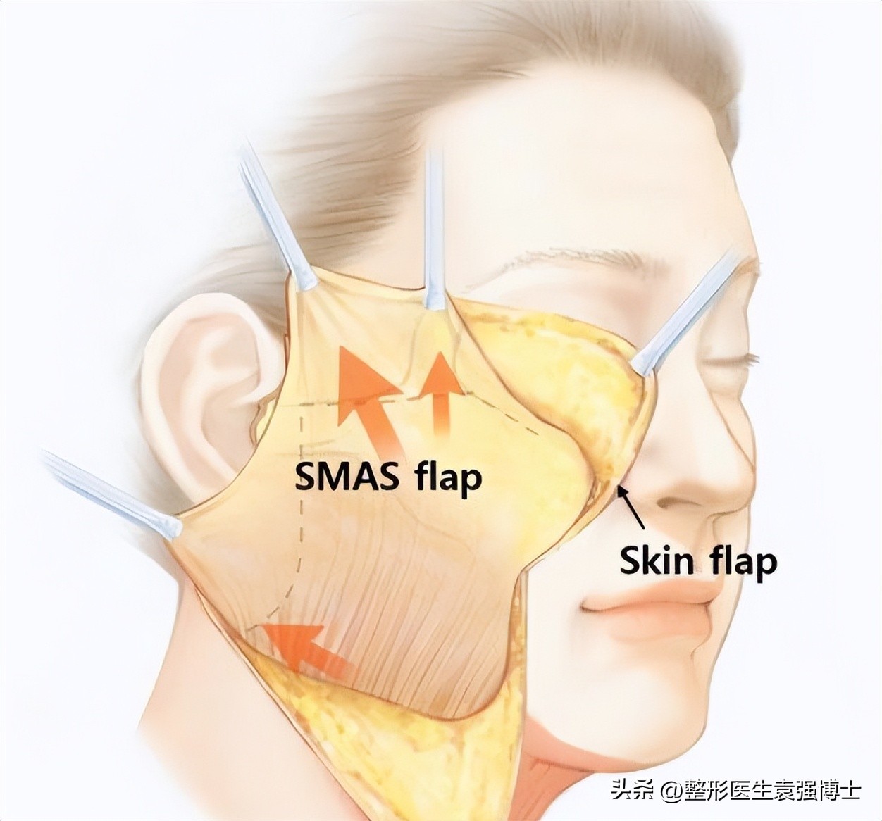 肚子拉皮手术后会有哪些后遗症,做拉皮会有什么风险有什么后遗症