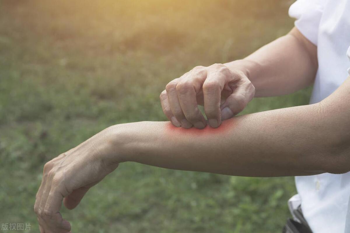睡觉一热皮肤就特别痒口服什么药,睡觉一热皮肤痒怎么回事