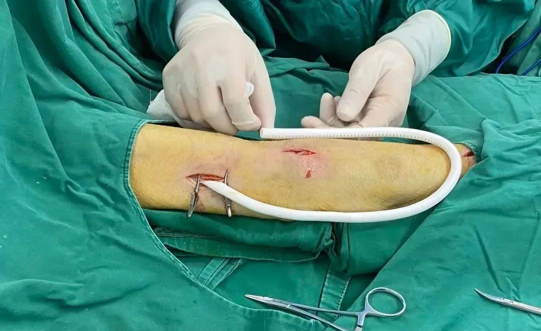 血管造瘘透析,血管人工搭桥