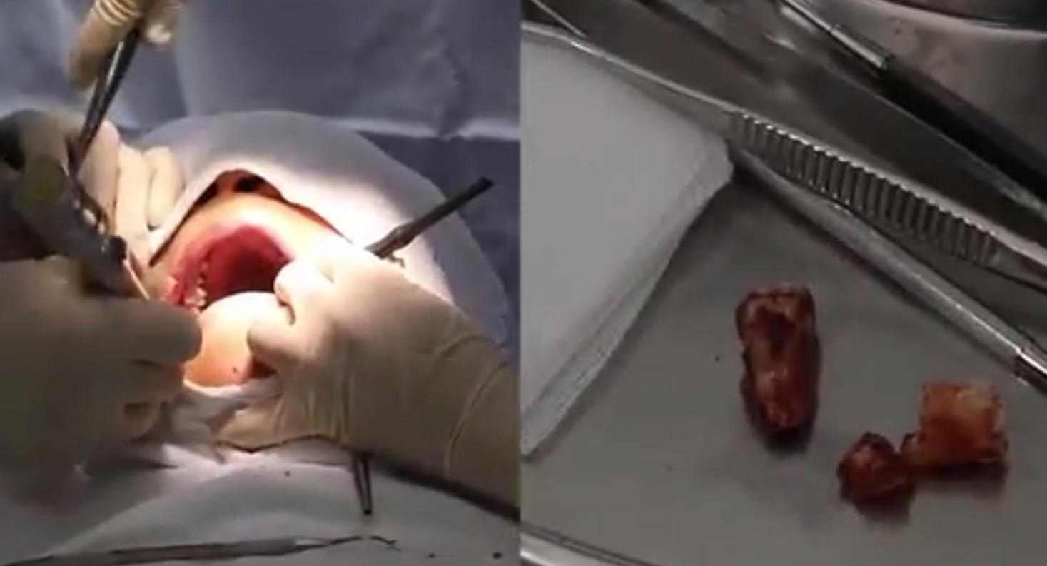 拔牙一周牙龈隐隐疼是干槽症吗,为什么拔牙后三天就排除干槽症