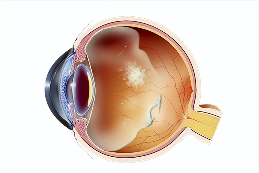 感觉眼前有东西飘过怎么回事,眼前老是有东西在飘动