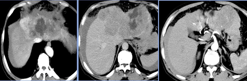 手术治疗癌症会好吗,手术介入化疗效果