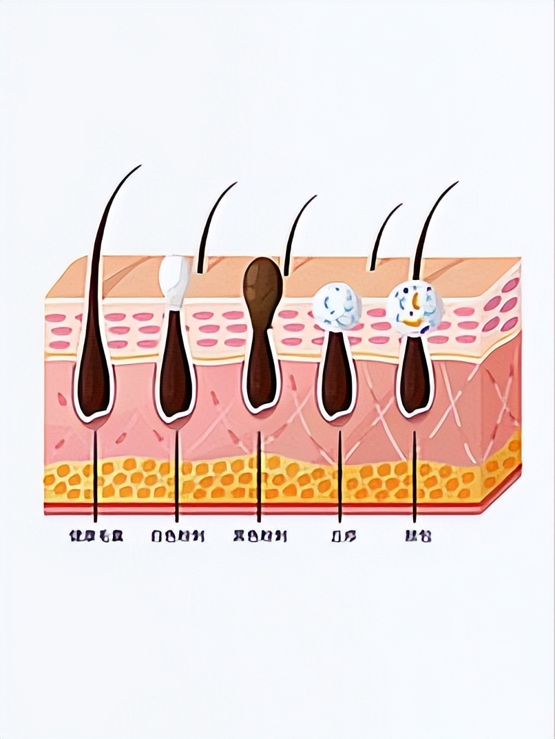 分享简单去黑头的方法,去黑头最有效的方法和攻略