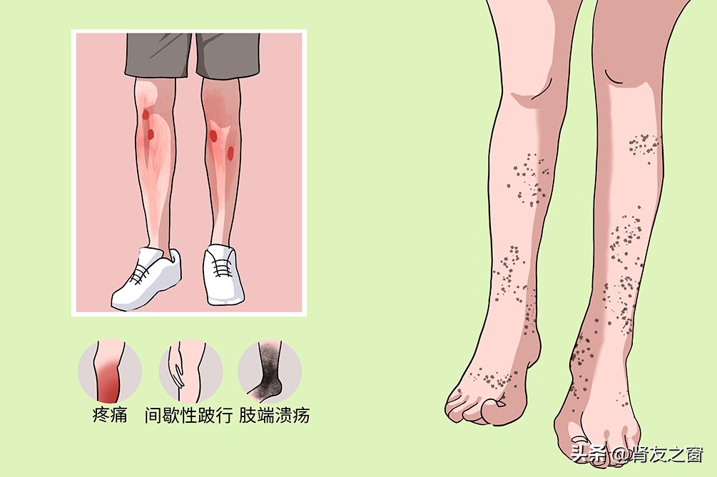 血栓闭塞性脉管炎用什么药,糖尿病足与血栓闭塞性脉管炎鉴别