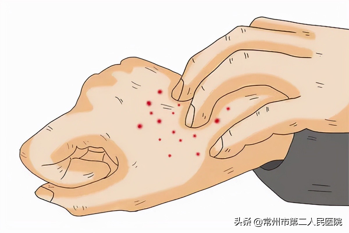 儿童手脚发热发痒是怎么回事,酒后手脚发红发痒是怎么回事