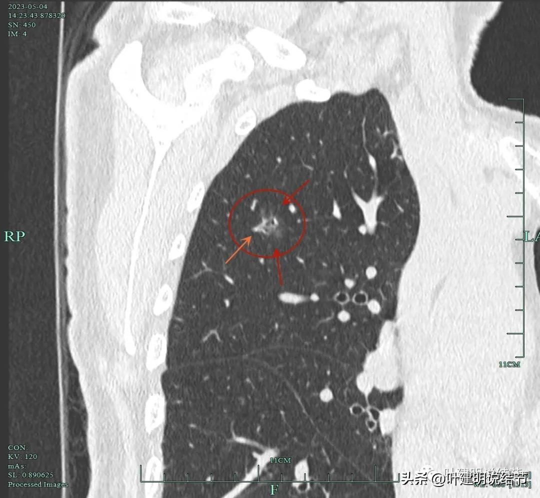 肺楔形切除肺功能降低,肺楔形切除需要缝合吗