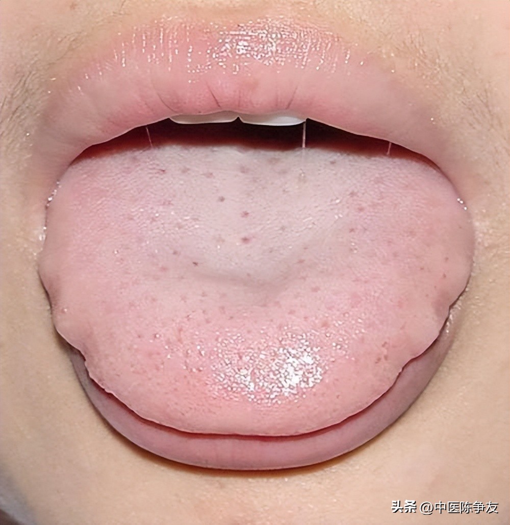 痰湿重的舌象以及症状,胖大舌有齿痕湿气重如何吃中药