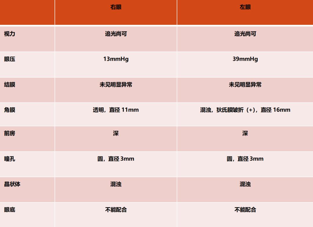 lowe综合征,继发性青光眼临床症状