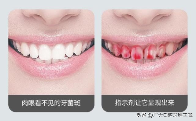 牙齿老是发黄有牙渍怎么办,牙齿里面根部黄渍去除小妙招