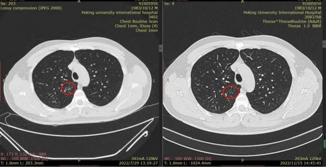 磨玻璃结节9*8mm建议随访,8mm磨玻璃结节一年没长