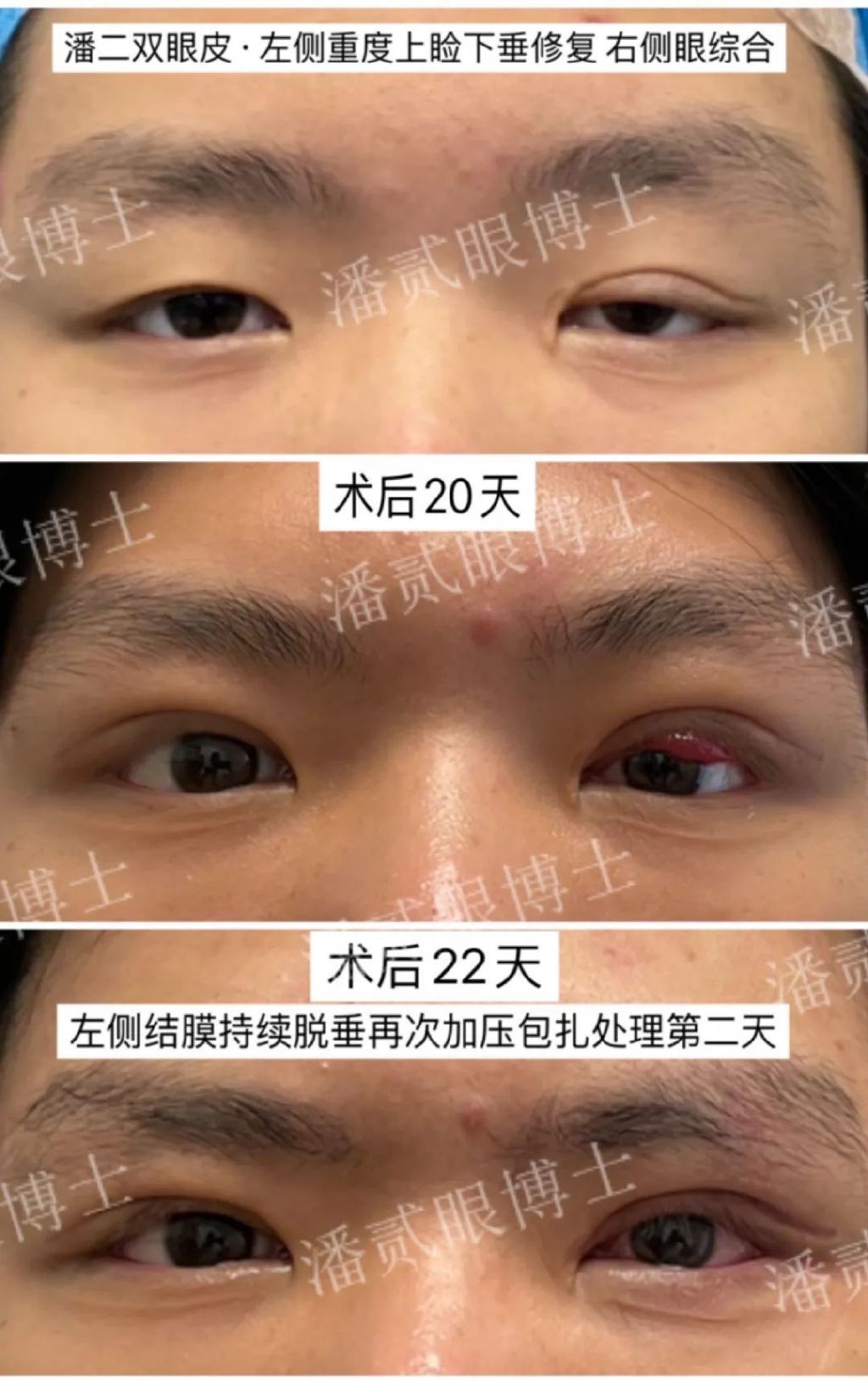 术后（重度上睑下垂）出现结膜脱垂怎么办？