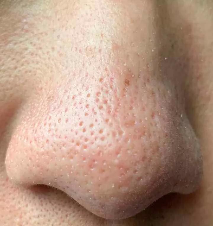 改善黑头毛孔粗大真的假的,黑头毛孔粗大脸油如何改善