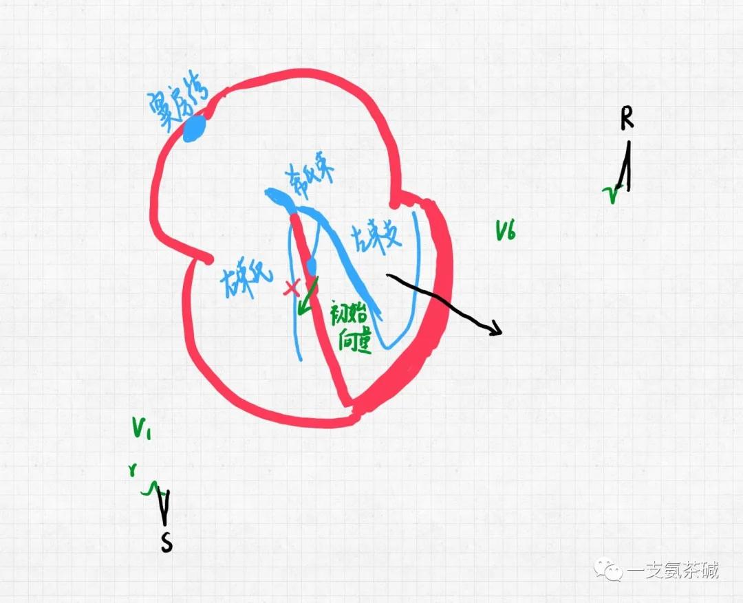 心电图临界异常右束支传导阻滞,心电图十二导和十八导