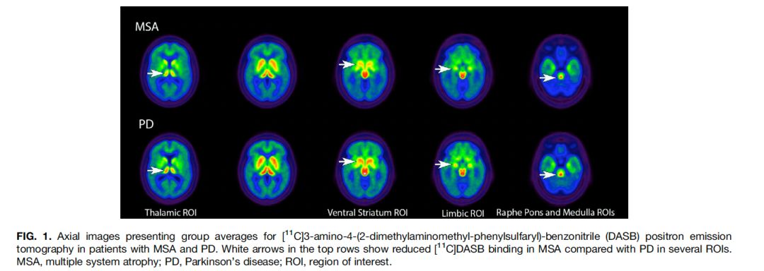 世界帕金森病日第28个主题,世界帕金森病日完整版