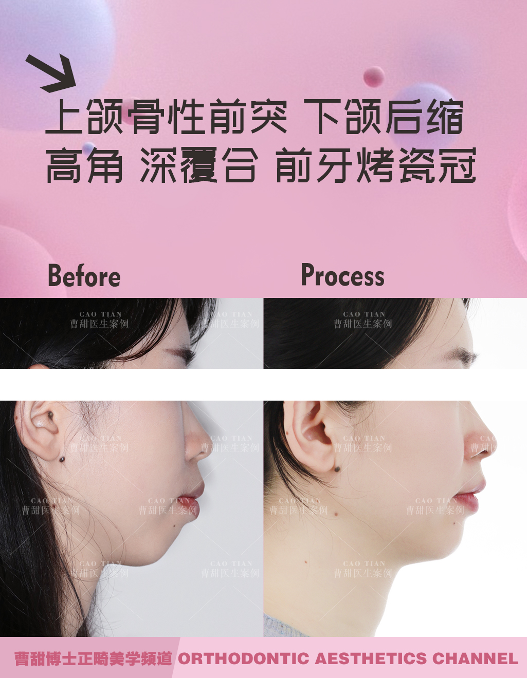 不拔牙矫正嘴凸下巴后缩案例,嘴瘪不拔牙矫正嘴会凸怎么办