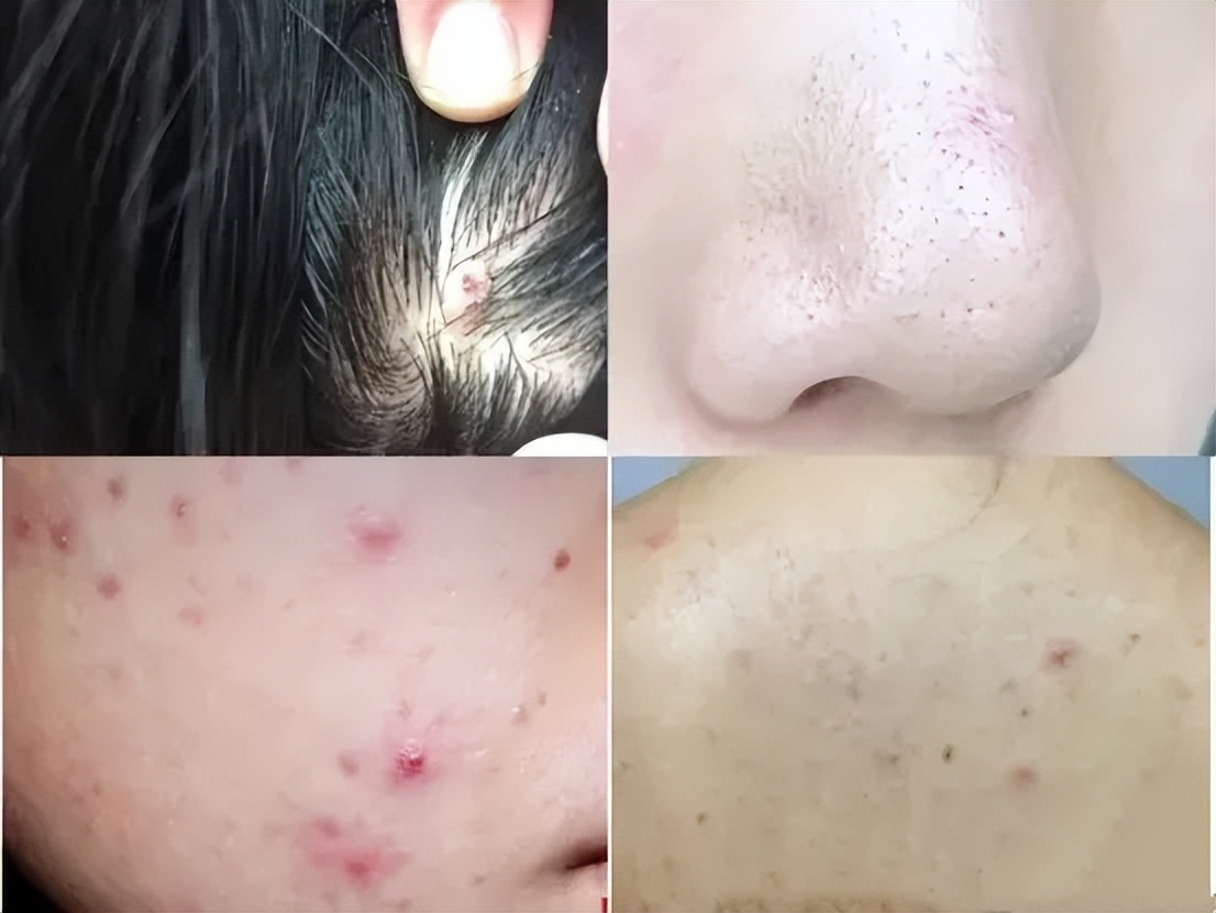 怎么对付螨虫的最好方法,如何正确的去处理螨虫