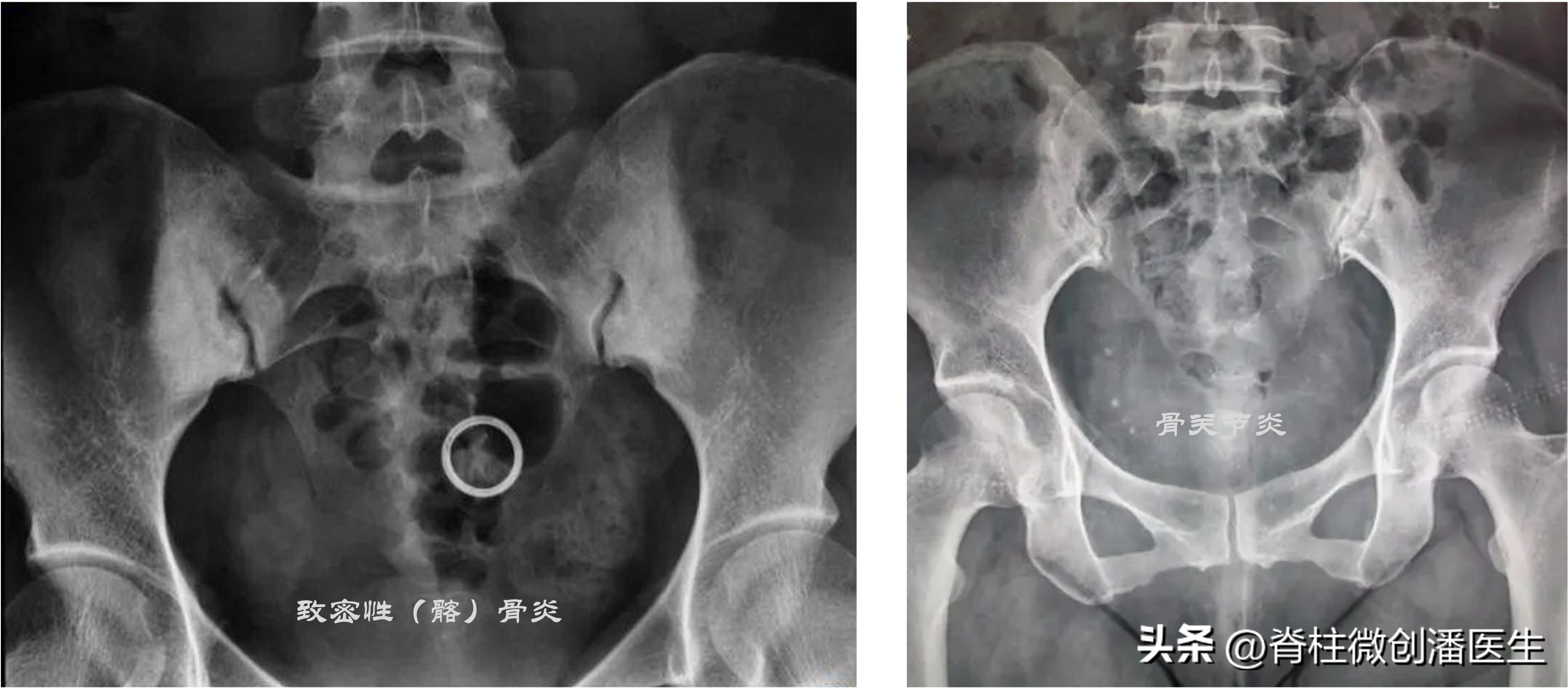 骶髂关节痛最好的锻炼方法,打喷嚏骶髂关节痛怎么回事