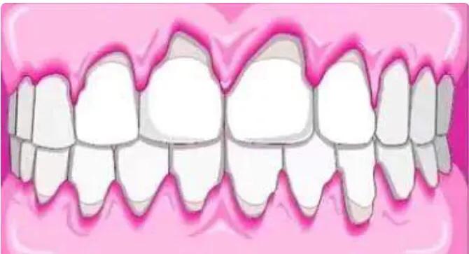 牙龈出血牙齿松动算牙周炎吗,牙龈出血牙周病怎么治疗最好