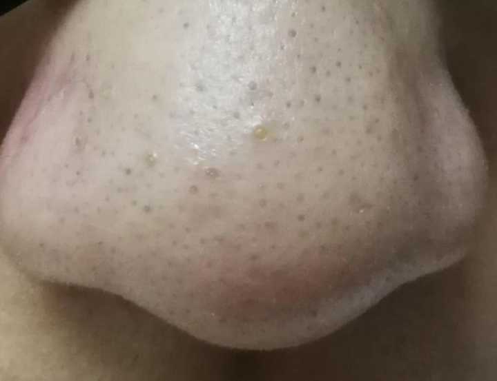 20年的黑头有多大,世界上最长的黑头到底有多长