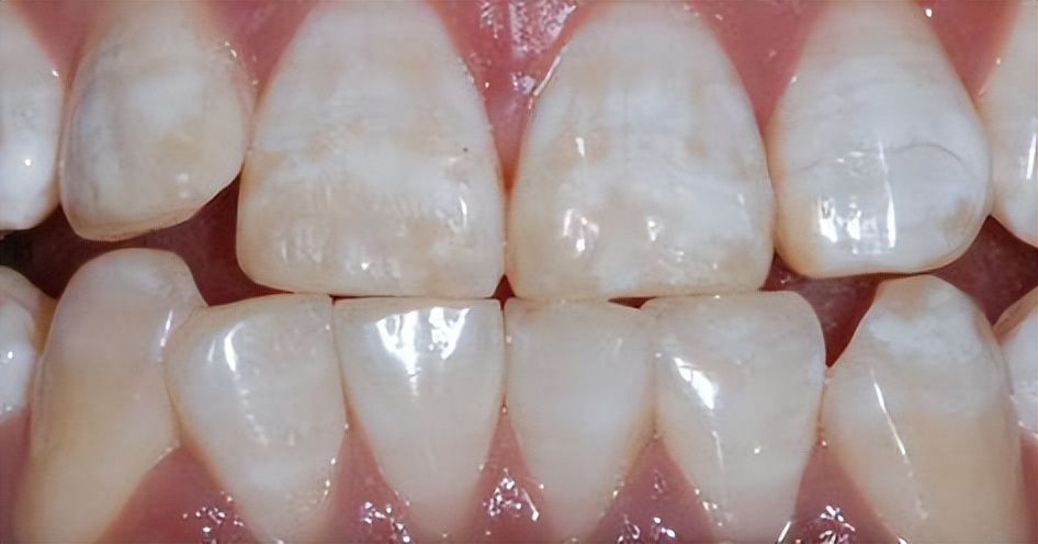 牙齿钙化是什么原因导致的,牙齿钙化了是怎么回事