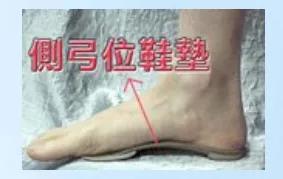 扁平足发病机制,扁平足诊断标准示意图