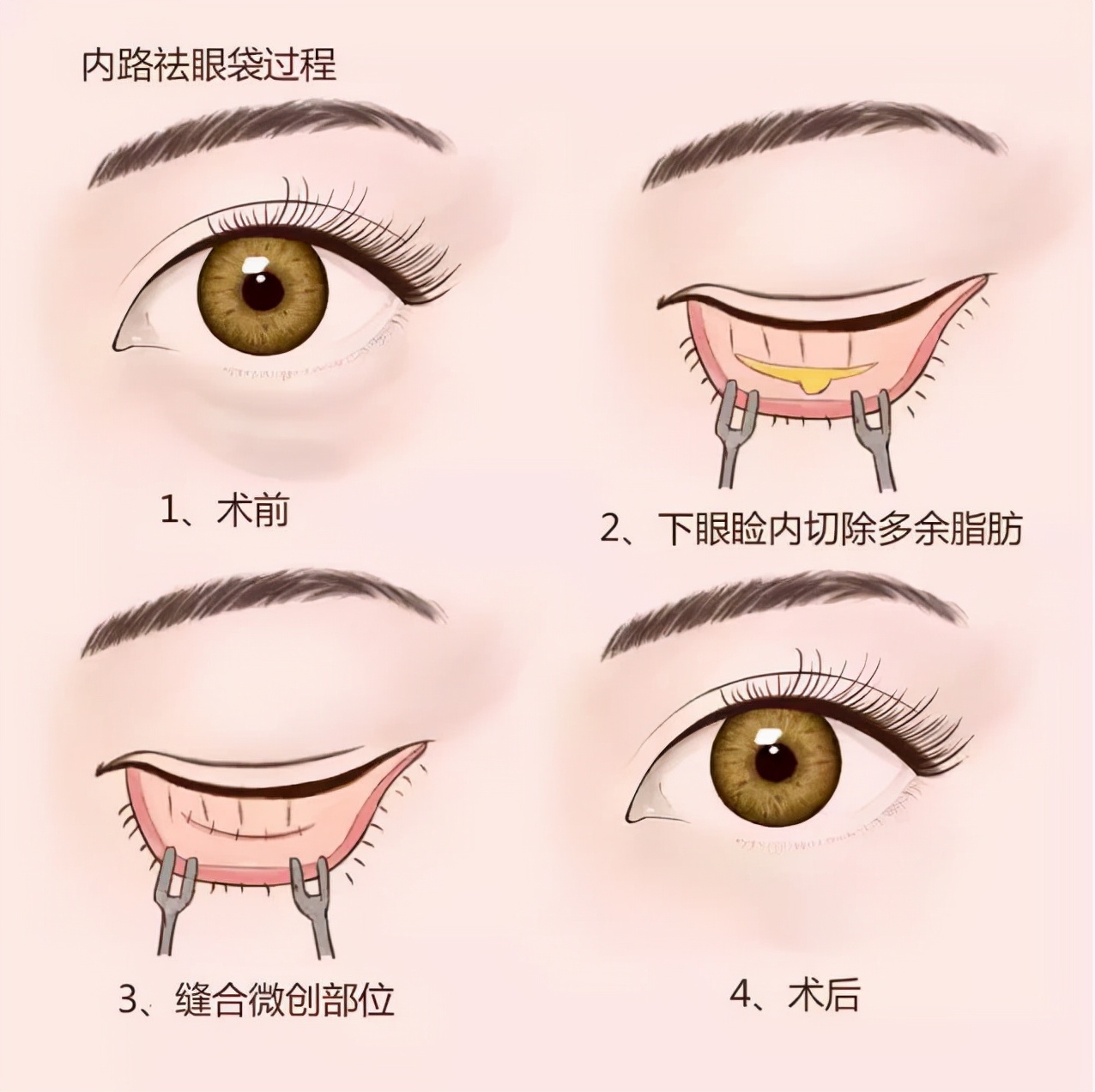 微整切眉去眼袋可以年轻多少岁,有几种快速去眼袋的方法