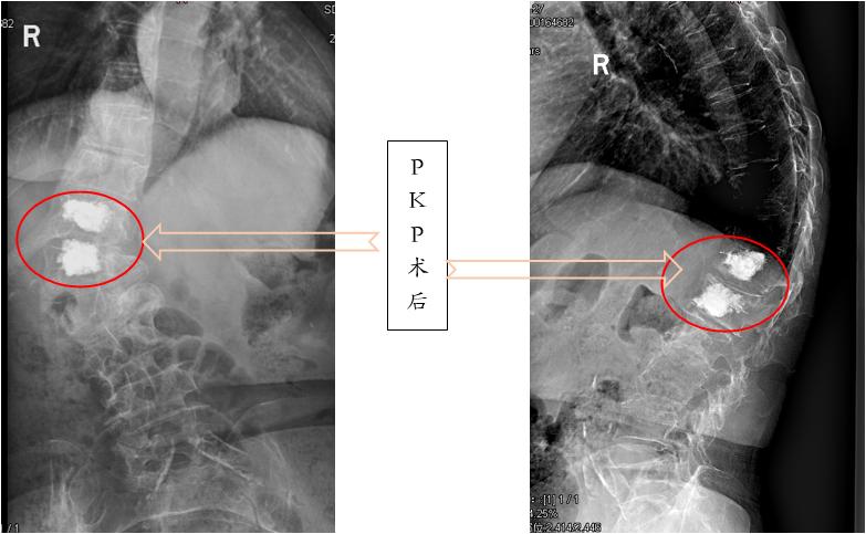 胸腰椎压缩性骨折特色治疗方法,老年人胸腰椎骨折怎么治疗